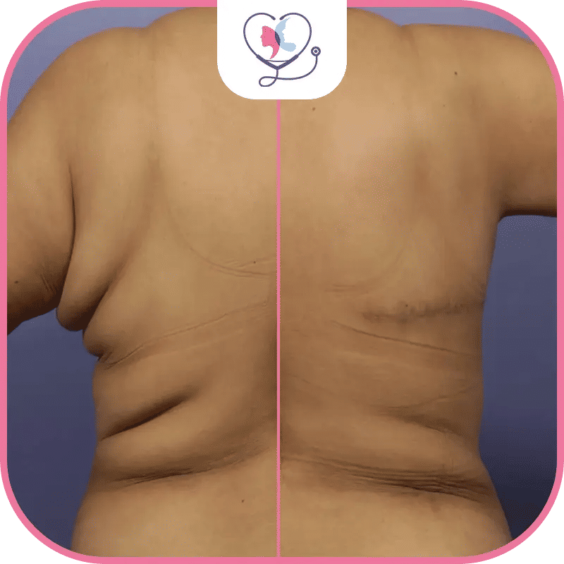 سعر عملية شد الظهر في تركيا