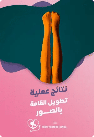 نتائج عملية تطويل القامة بالصور قبل وبعدfeatured image