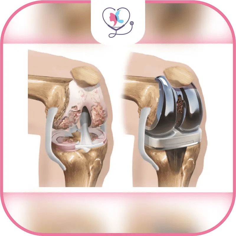 Why is Total Knee Replacement so Common?