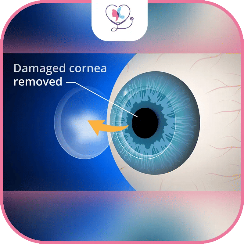 تكلفة زراعة القرنية في تركيا