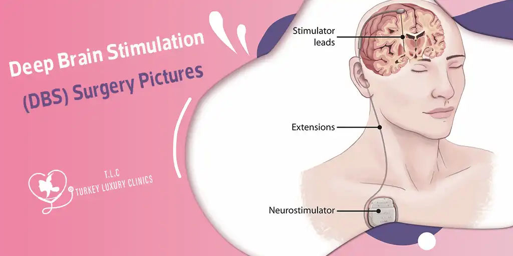 Deep Brain Stimulation Surgery Pictures Explained