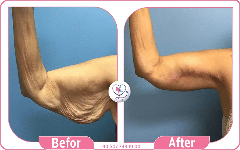 before and after brachioplasty surgery showing skin removal by top arm lift surgeons