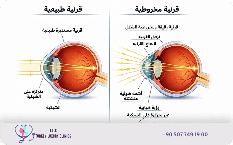 الفرق بين القرينة المخروطية الرقيقة و الطبيعية