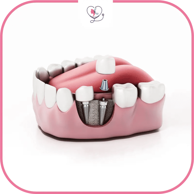 bridge dentaire ou implant