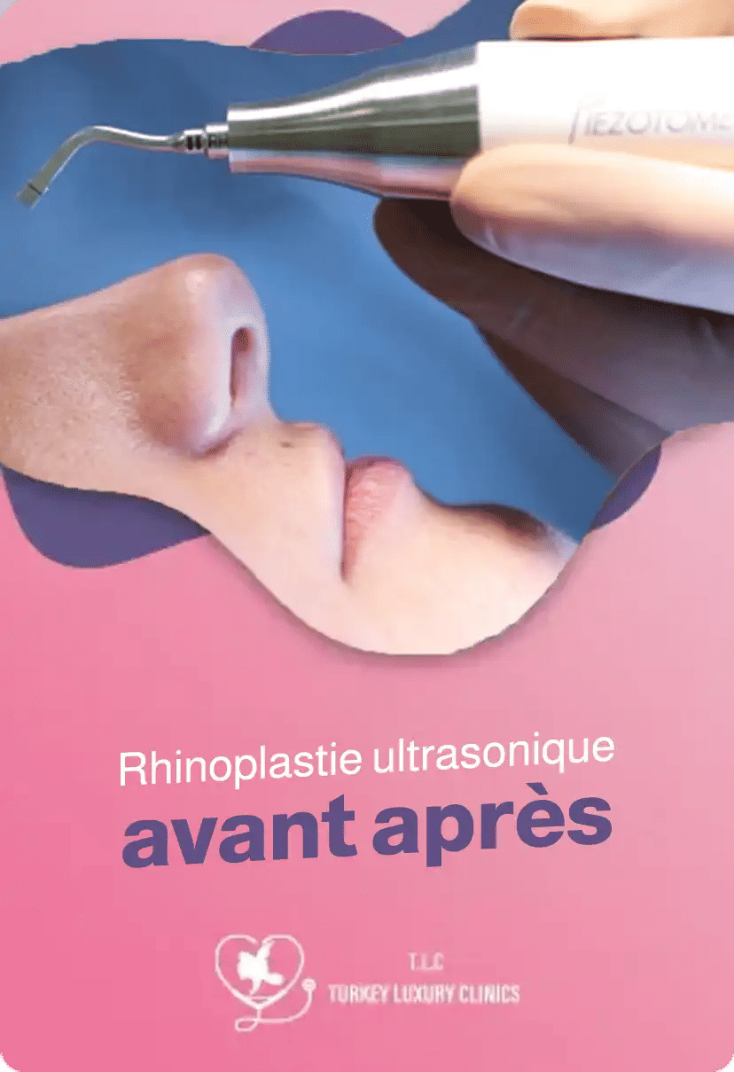 Rhinoplastie ultrasonique avant après: résultats naturels