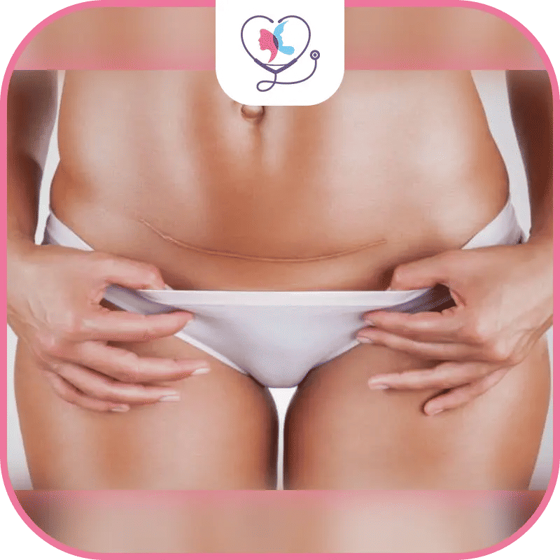 عملية شد البطن المصغرة