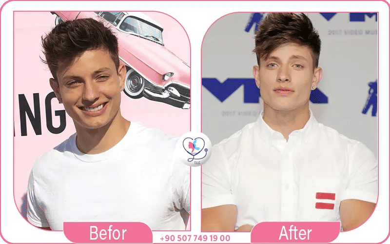 Matt Rife Plastic Surgery Photos