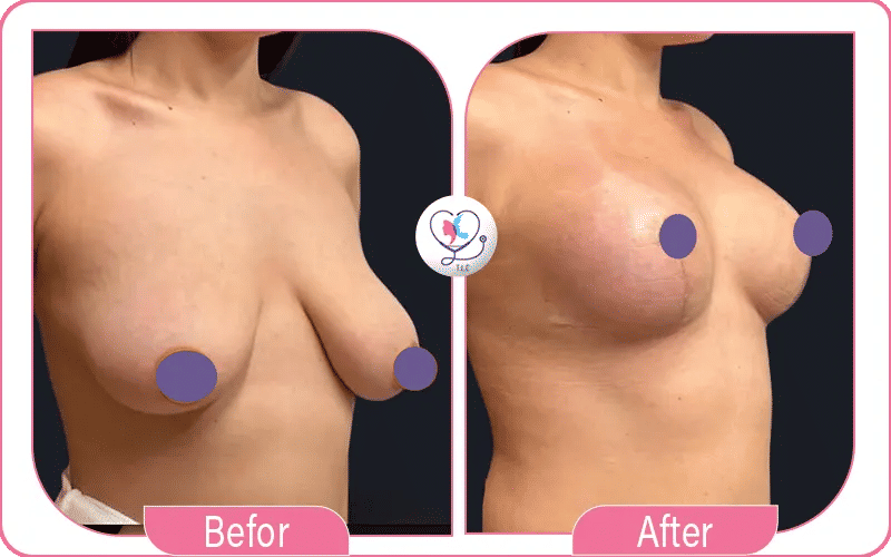 Liposuction Breast Reduction Results