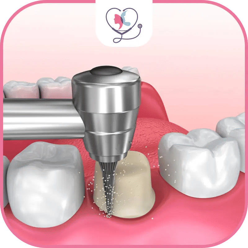 ما هو تلبيس الأسنان؟