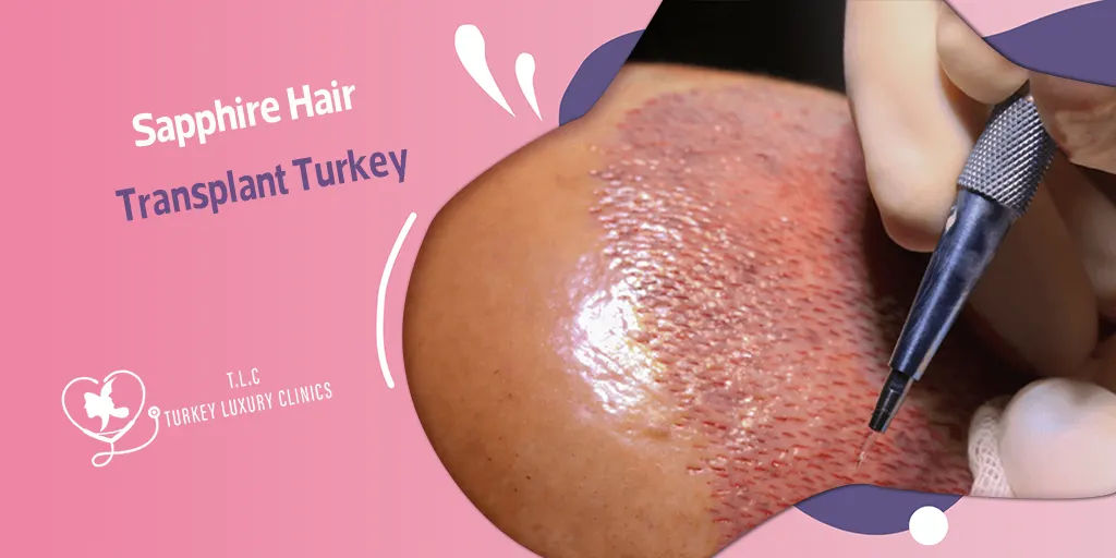 Trasplante Capilar Zafiro en Turquía: Cabello Denso a Precio Accesible