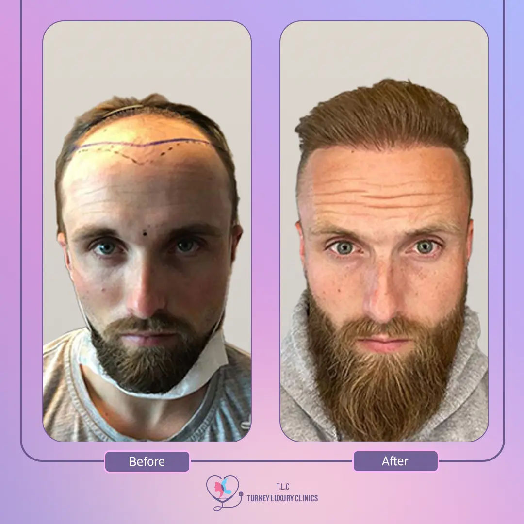 أهم مضاعفات عملية زراعة الشعر وكيفية تجنبها