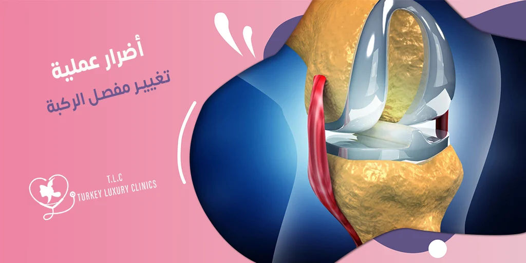 أضرار عملية تغيير مفصل الركبة: هل تمنعك من إجراء العملية؟