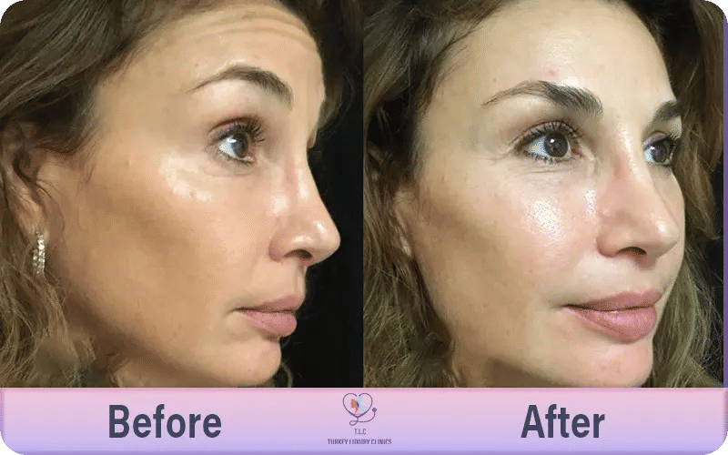 Achieve a Natural Brow Lift with Confidence at Turkey Luxury Clinics