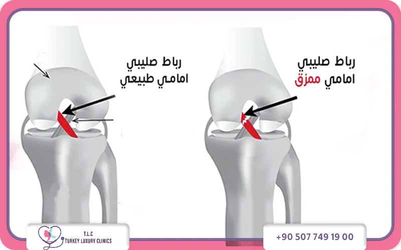 ما هو تمزق الرباط الصليبي الأمامي؟