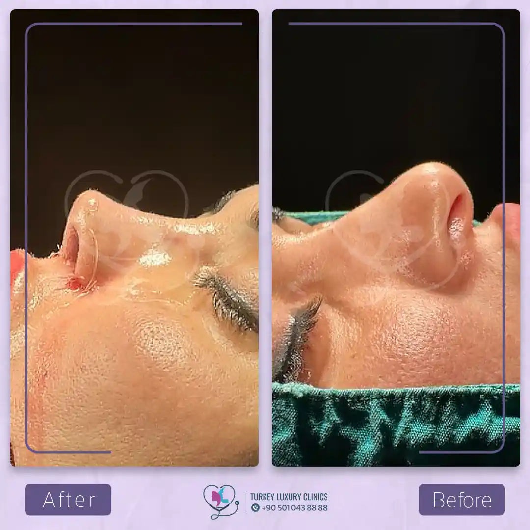 خطوات جراحة تجميل الأنف