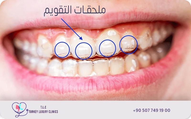 كيف يثبت على الأسنان