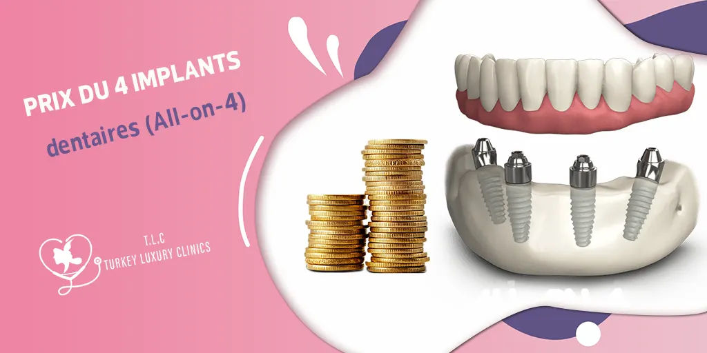 Prix du 4 implants dentaires (All-on-4)