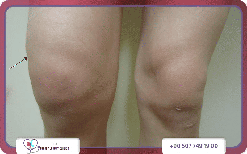 شكل الركبة قبل عملية الرباط الصليبي