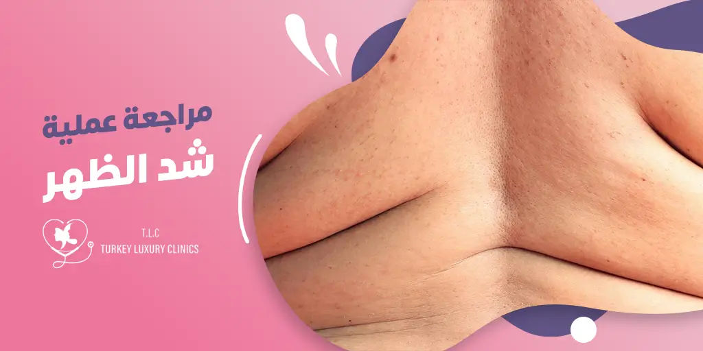 مراجعة عملية شد الظهر