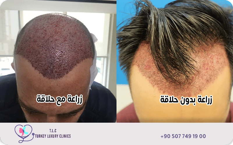 أضرار زراعة الشعر بدون حلاقة أضرار زراعة الشعر بدون حلاقة