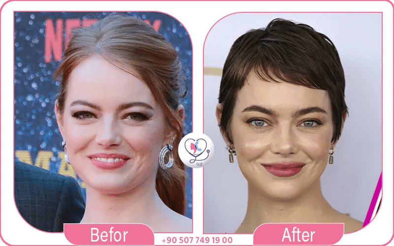 Emma Stone Plastic Surgery 2024