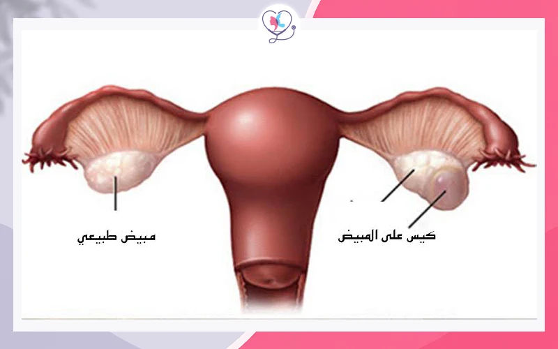 أكياس المبيض