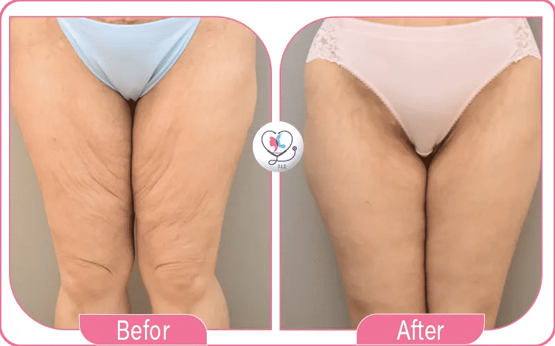 تجربتي في شد ترهلات فخذين