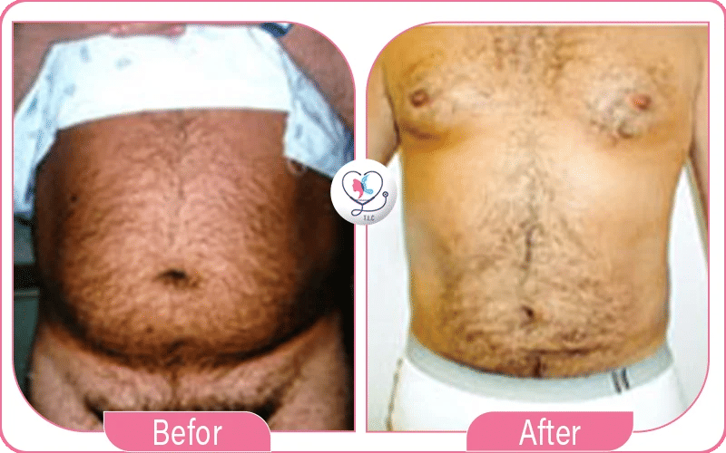 What Is Male 360 Liposuction?