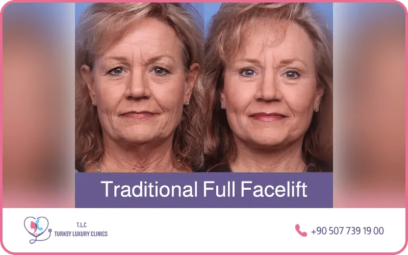 Lifting facciale tradizionale completo prima e dopo – risultati di ringiovanimento facciale completo presso Turkey Luxury Clinics Istanbul