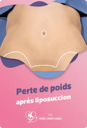 Liposuccion WAL en Turquie : Méthode douce pour un remodelage précisfeatured image