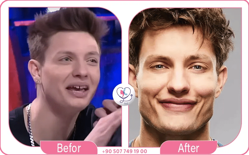 Matt Rife Jaw Plastic Surgery