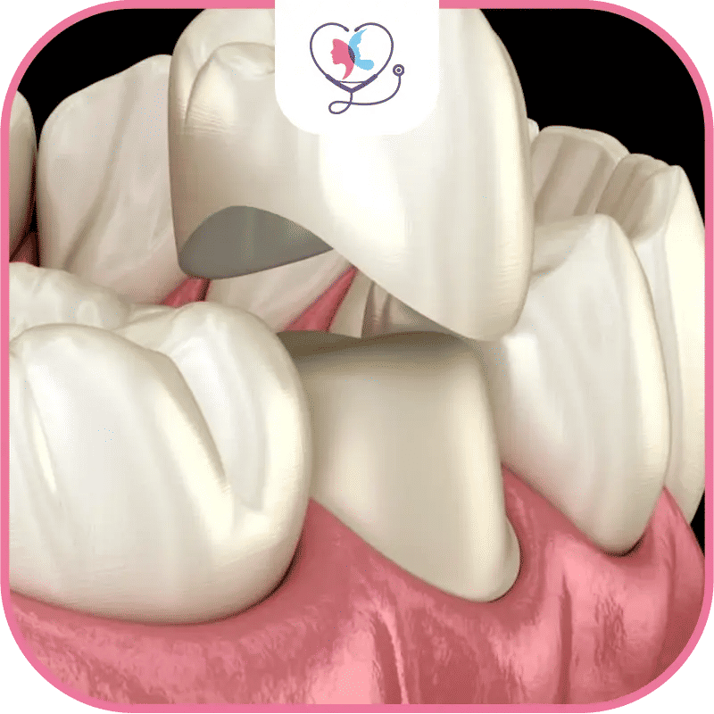 Qu'est-ce qu'une couronne dentaire sur racine ?