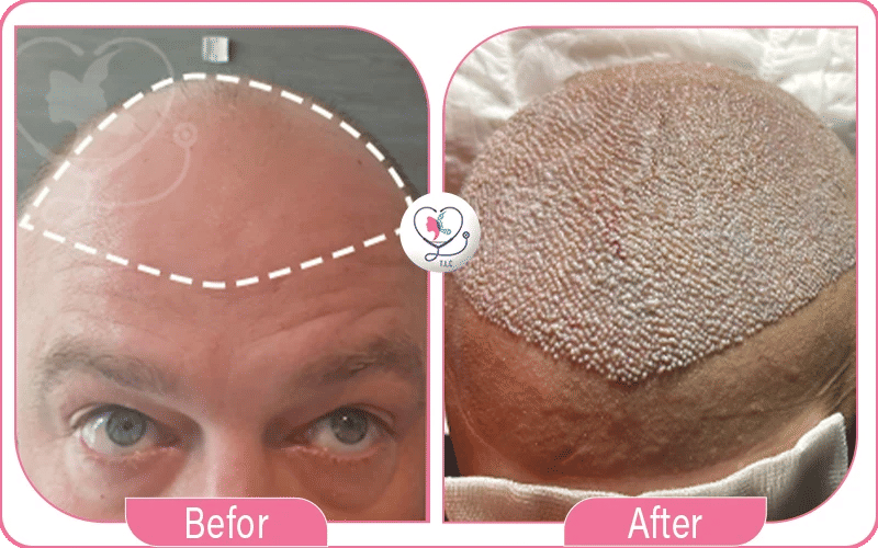 شاهد صور قبل وبعد زراعة الشعر في تركيا: