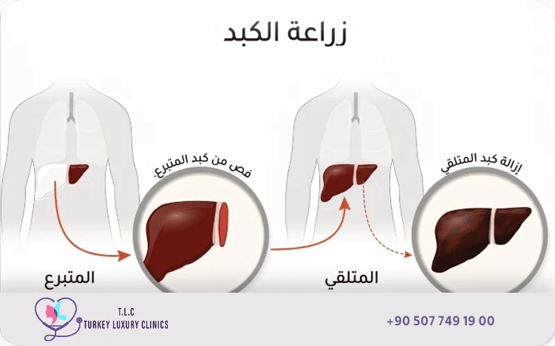 زراعة الكبد