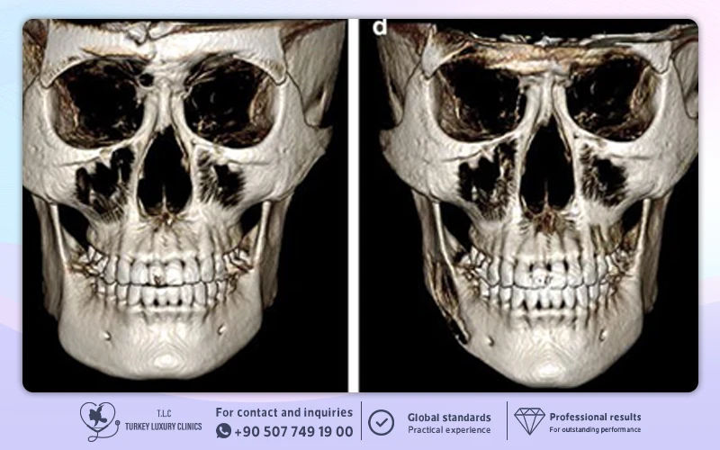 Extent of bone reduction