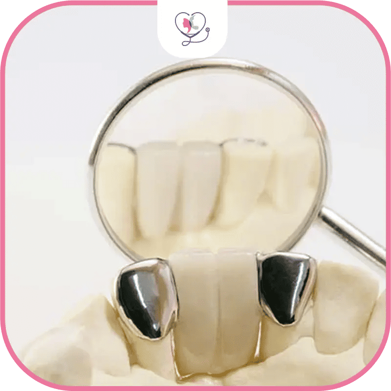 Étapes de la pose d’un bridge dentaire