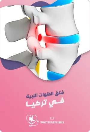 فتق القنوات اللبية في تركياfeatured image