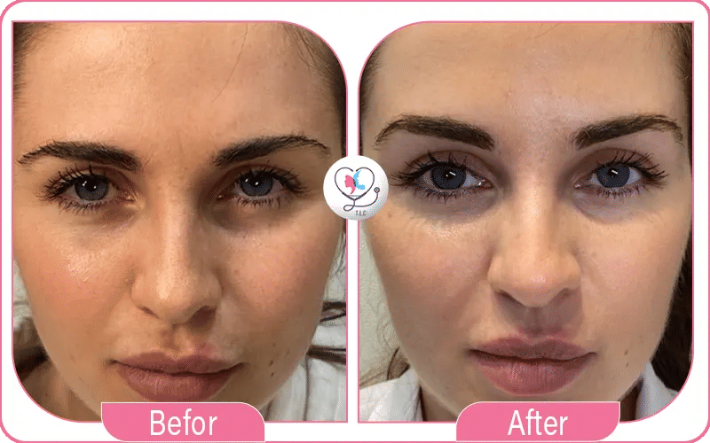 تجربتي مع رفع الحواجب في تركيا