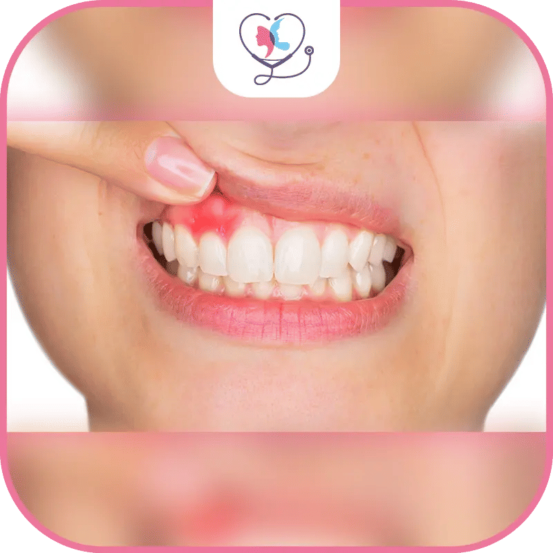 ما هو التهاب اللثة؟