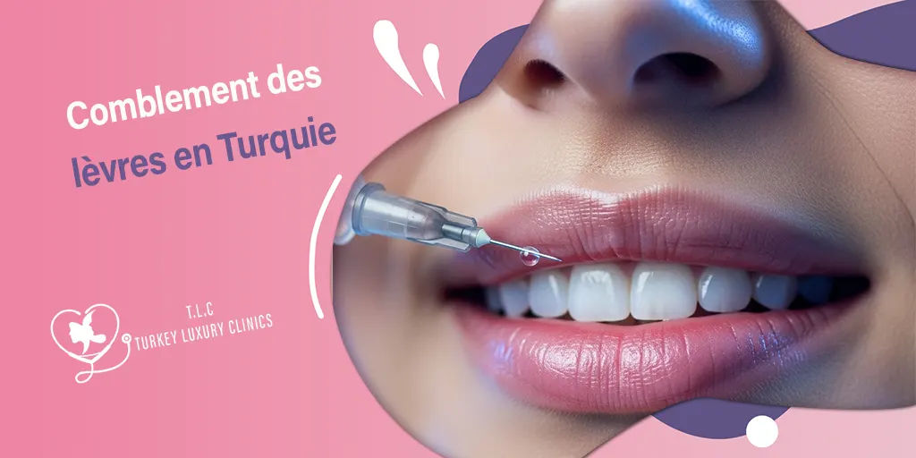Augmentation des lèvres en Turquie : Le guide pour une bouche naturelle et sublimée