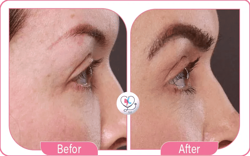 Female Eyebrow Transplant Before and After