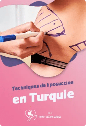 Techniques de liposuccion en Turquie : Trouvez la méthode adaptée à vos besoinsfeatured image