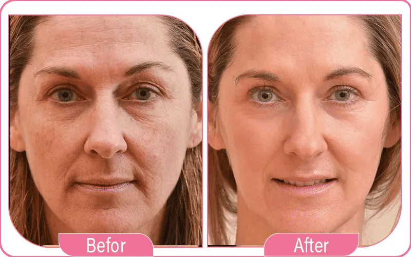 Non Surgical Facelift Before and After Photos