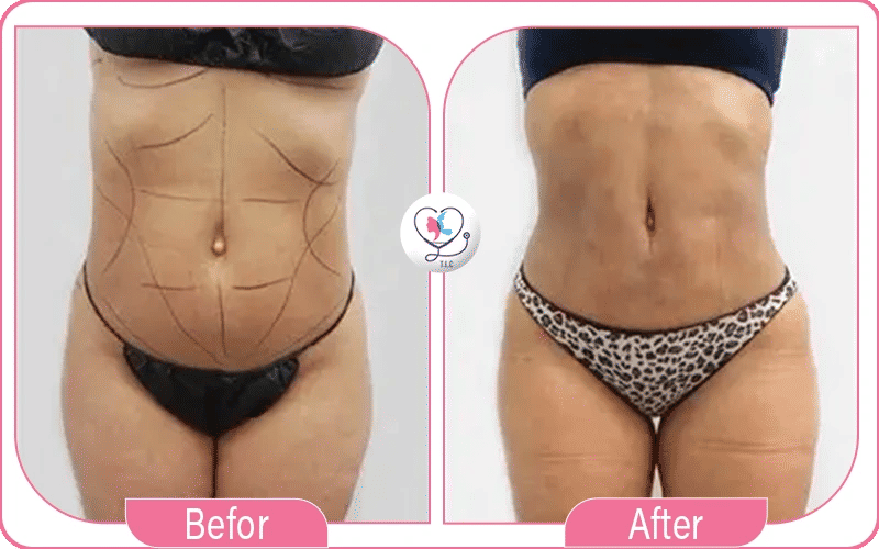 What is Lipo 360?
