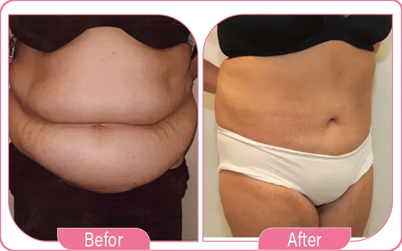 Loose Skin After Weight Loss