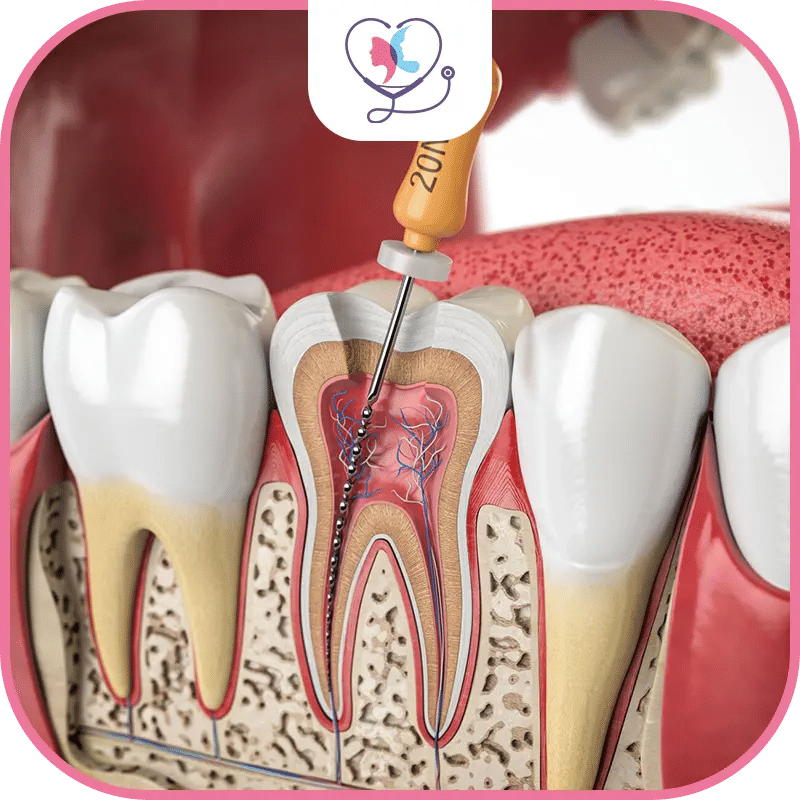 ماهي العلاجات اللبية أو "معالجة قناة الجذر"؟