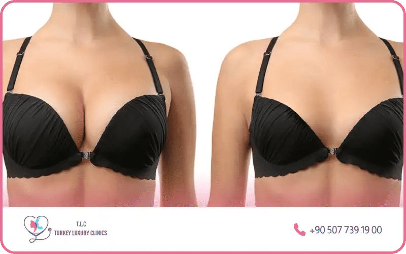 تكبير الثدي سيليكون مقاس 350 في تركيا لاكشري كلينك
