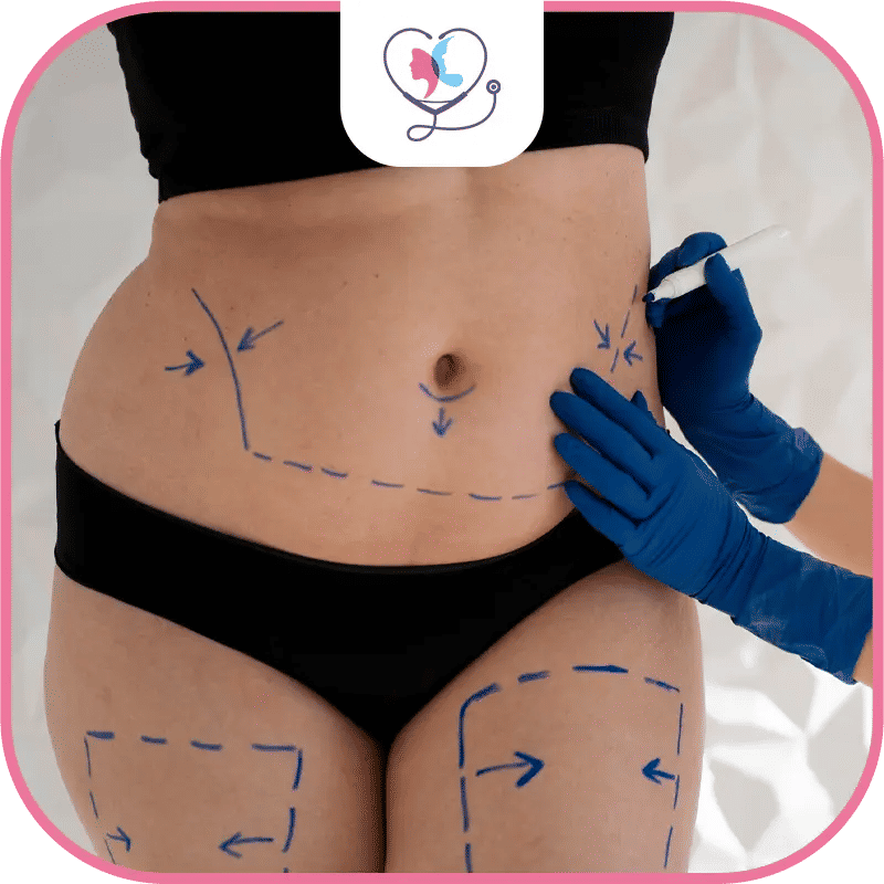 التحضير لعملية شفط الدهون للنساء