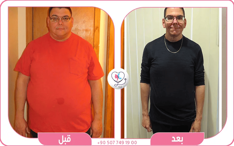 من هو المرشح المناسب لعملية تحويل مسار المعدة