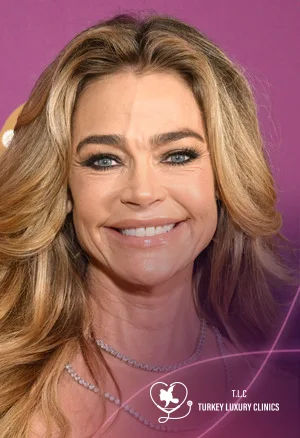 Denise Richards Plastic Surgery: 2026 Before and After 